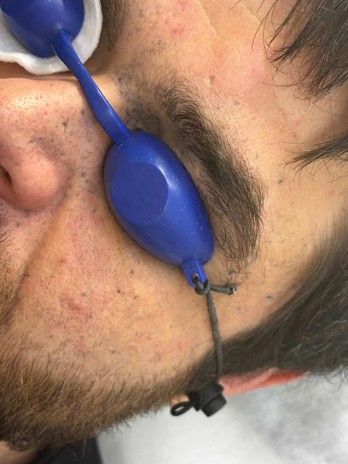 Сліди від пороху на обличчі